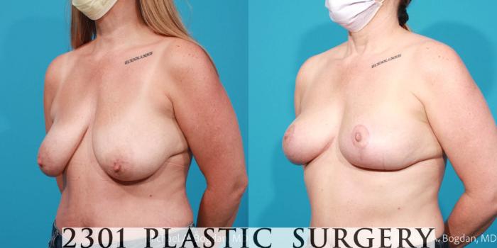 Before & After Breast Augmentation Case 720 Left Oblique View in Fort Worth, Plano, & Frisco, Texas