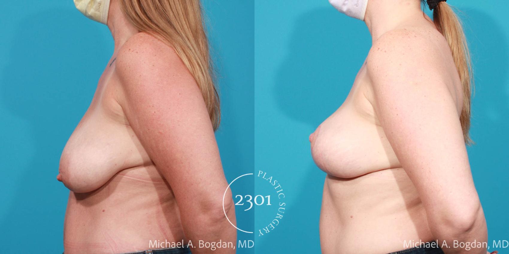 Before & After Silicone Implants Case 720 Left Side View in Fort Worth, Plano, & Frisco, Texas