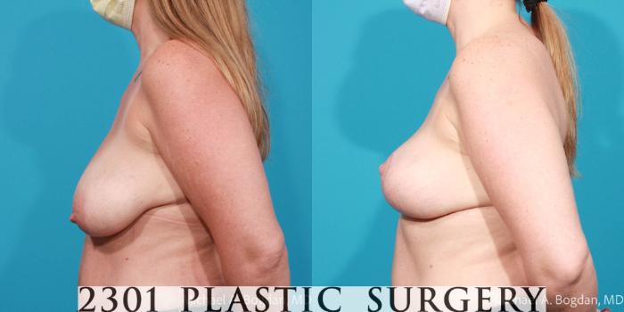 Before & After Breast Augmentation Case 720 Left Side View in Fort Worth, Plano, & Frisco, Texas