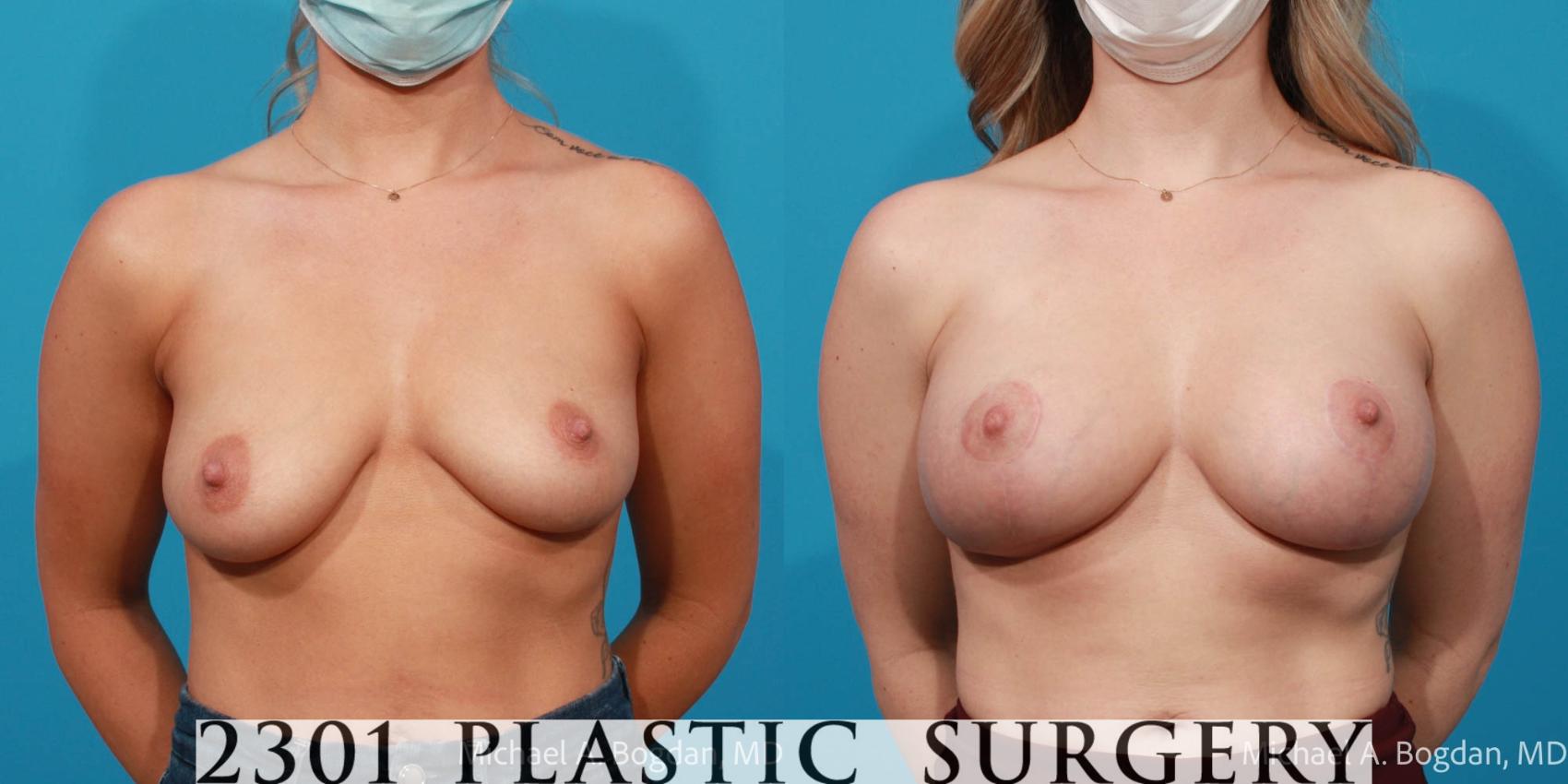 Before & After Silicone Implants Case 729 Front View in Fort Worth, Plano, & Frisco, Texas