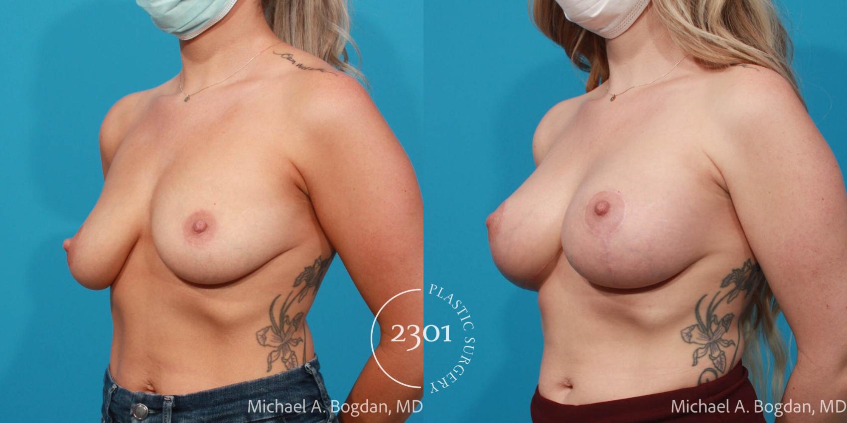 Before & After Breast Augmentation Case 729 Left Oblique View in Fort Worth, Plano, & Frisco, Texas