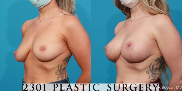 Before & After Breast Augmentation Case 729 Left Oblique View in Fort Worth, Plano, & Frisco, Texas