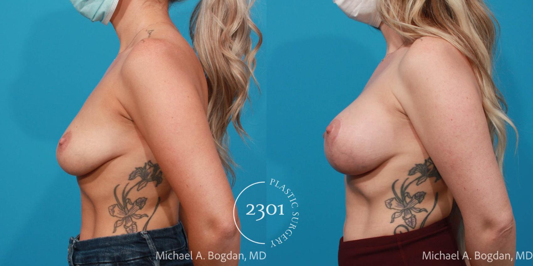Before & After Breast Augmentation Case 729 Left Side View in Fort Worth, Plano, & Frisco, Texas