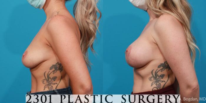 Before & After Silicone Implants Case 729 Left Side View in Fort Worth, Plano, & Frisco, Texas