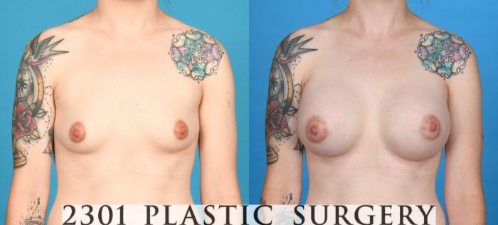 Before & After Breast Augmentation Case 733 Front View in Fort Worth, Plano, & Frisco, Texas