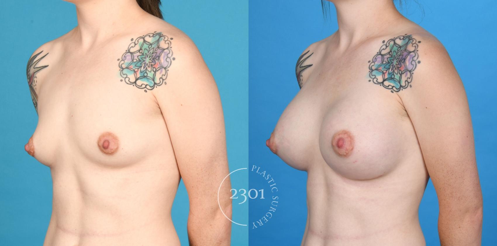 Before & After Breast Augmentation Case 733 Left Oblique View in Fort Worth, Plano, & Frisco, Texas