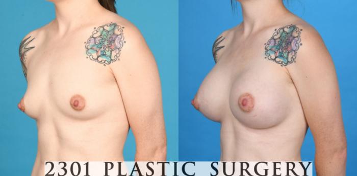 Before & After Breast Augmentation Case 733 Left Oblique View in Fort Worth, Plano, & Frisco, Texas