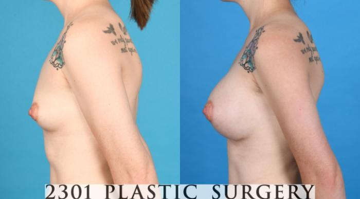 Before & After Silicone Implants Case 733 Left Side View in Fort Worth, Plano, & Frisco, Texas