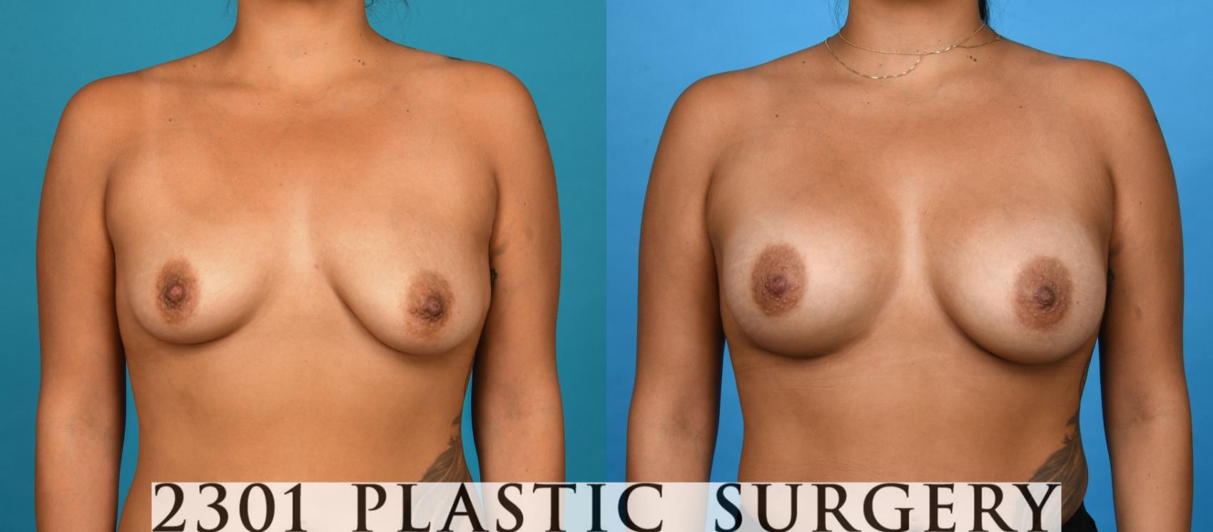 Before & After Breast Augmentation Case 738 Front View in Fort Worth, Plano, & Frisco, Texas