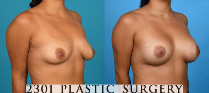 Before & After Breast Augmentation Case 738 Right Oblique View in Fort Worth, Plano, & Frisco, Texas