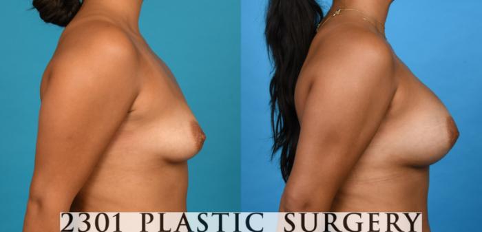 Before & After Silicone Implants Case 738 Right Side View in Fort Worth, Plano, & Frisco, Texas
