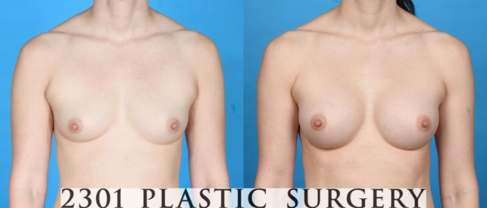 Before & After Silicone Implants Case 756 Front View in Fort Worth, Plano, & Frisco, Texas