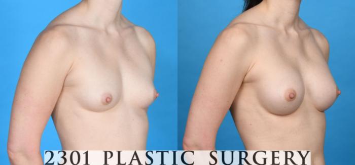 Before & After Breast Augmentation Case 756 Right Oblique View in Fort Worth, Plano, & Frisco, Texas