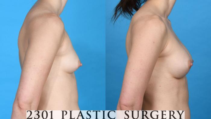 Before & After Silicone Implants Case 756 Right Side View in Fort Worth, Plano, & Frisco, Texas