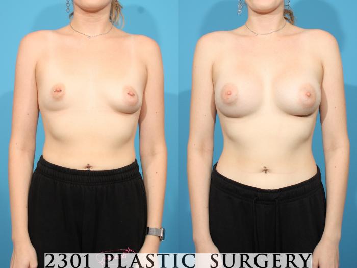 Before & After Breast Augmentation Case 767 Front View in Fort Worth, Plano, & Frisco, Texas