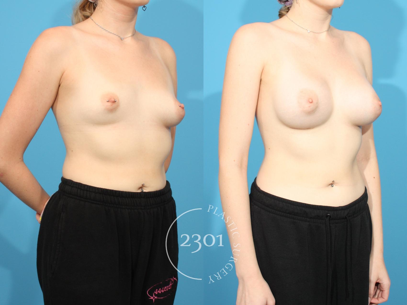 Before & After Breast Augmentation Case 767 Right Oblique View in Fort Worth, Plano, & Frisco, Texas