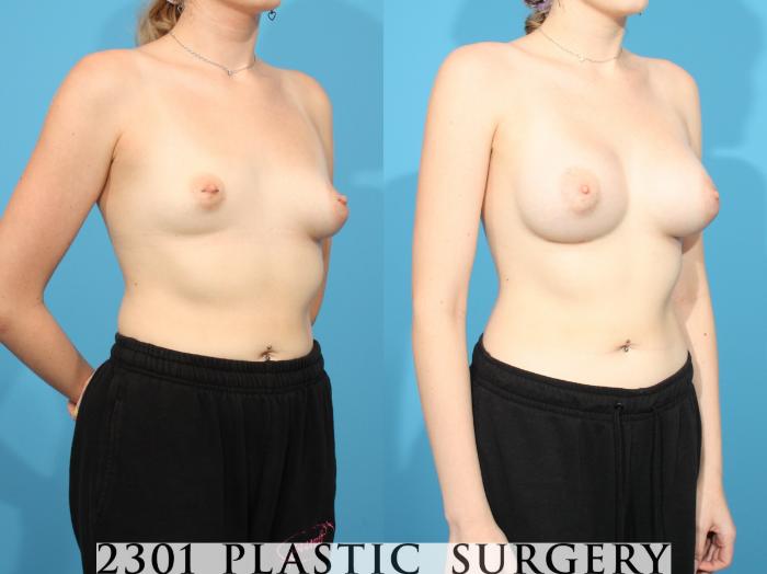 Before & After Breast Augmentation Case 767 Right Oblique View in Fort Worth, Plano, & Frisco, Texas