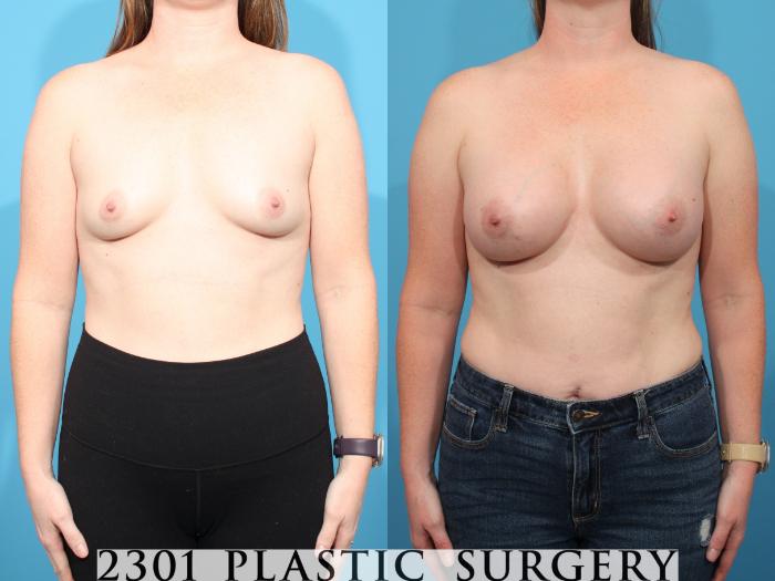 Before & After Silicone Implants Case 777 Front View in Fort Worth, Plano, & Frisco, Texas