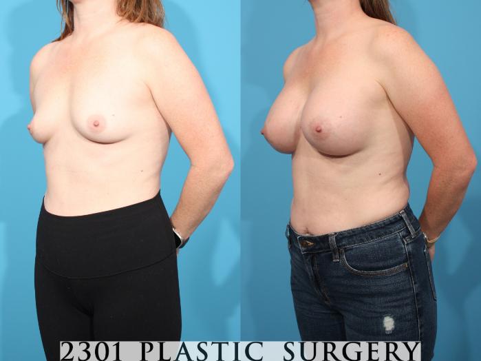 Before & After Breast Augmentation Case 777 Left Oblique View in Fort Worth, Plano, & Frisco, Texas