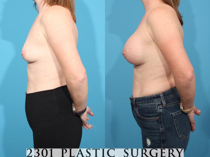 Before & After Breast Augmentation Case 777 Left Side View in Fort Worth, Plano, & Frisco, Texas