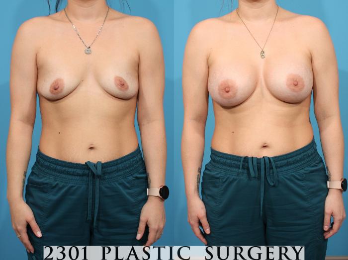 Before & After Breast Augmentation Case 778 Front View in Fort Worth, Plano, & Frisco, Texas