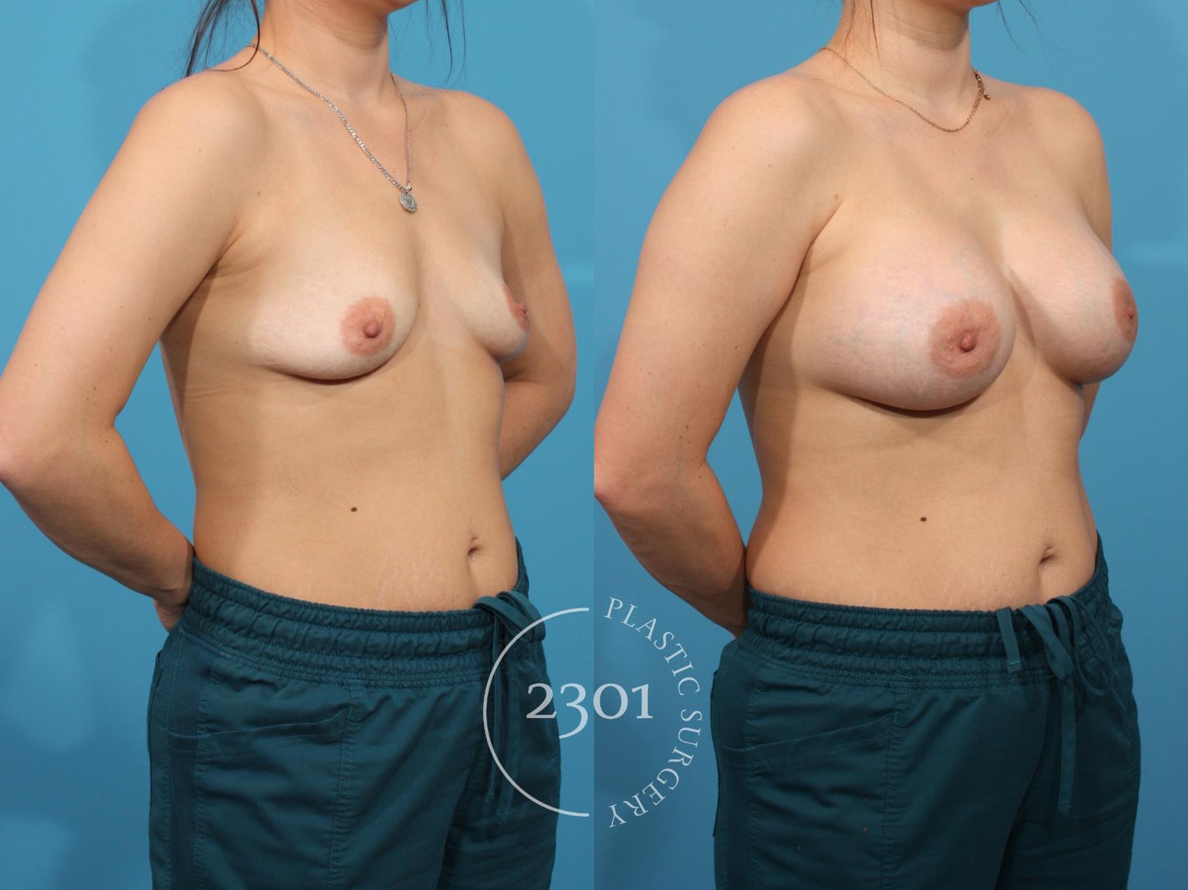 Before & After Breast Augmentation Case 778 Right Oblique View in Fort Worth, Plano, & Frisco, Texas