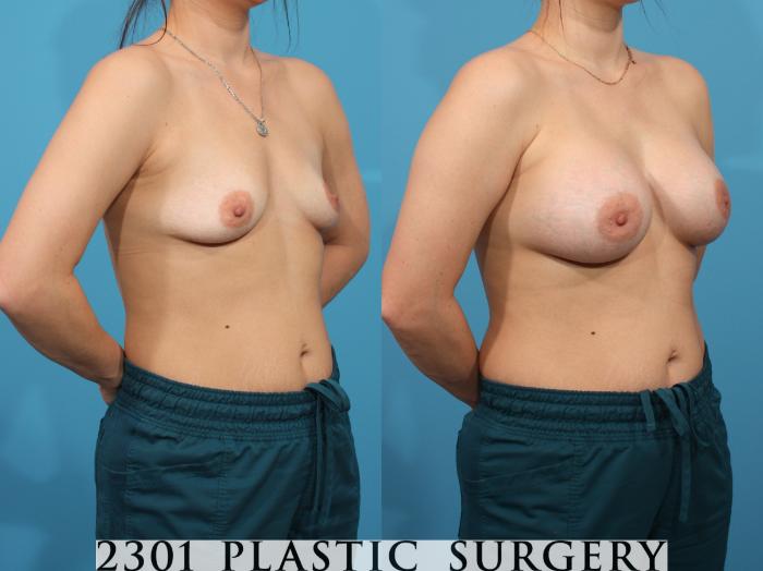 Before & After Breast Augmentation Case 778 Right Oblique View in Fort Worth, Plano, & Frisco, Texas