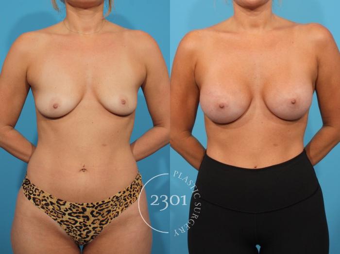 Before & After Breast Augmentation Case 812 Front View in Fort Worth, Plano, & Frisco, Texas