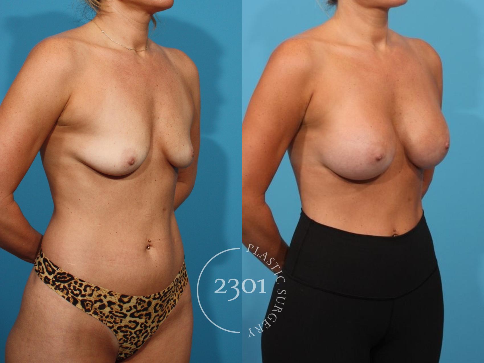 Before & After Breast Augmentation Case 812 Right Oblique View in Fort Worth, Plano, & Frisco, Texas