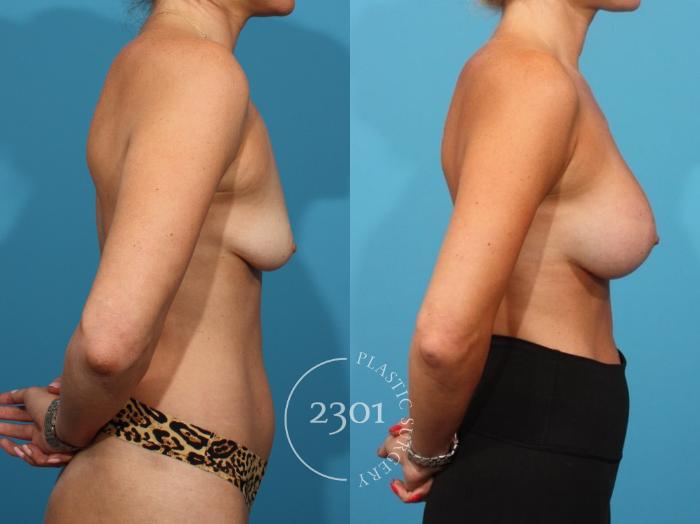 Before & After Breast Augmentation Case 812 Right Side View in Fort Worth, Plano, & Frisco, Texas