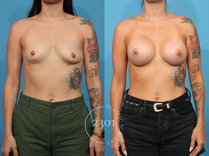 Before & After Breast Augmentation Case 815 Front View in Fort Worth, Plano, & Frisco, Texas