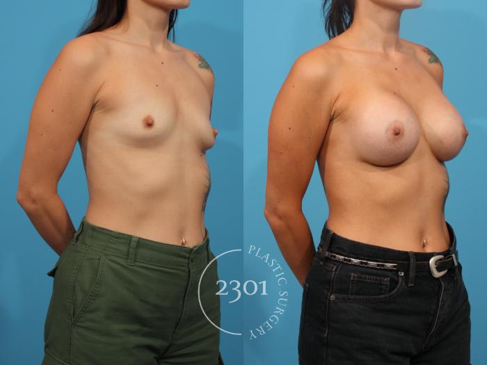 Before & After Breast Augmentation Case 815 Right Oblique View in Fort Worth, Plano, & Frisco, Texas