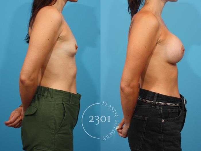 Before & After Breast Augmentation Case 815 Right Side View in Fort Worth, Plano, & Frisco, Texas