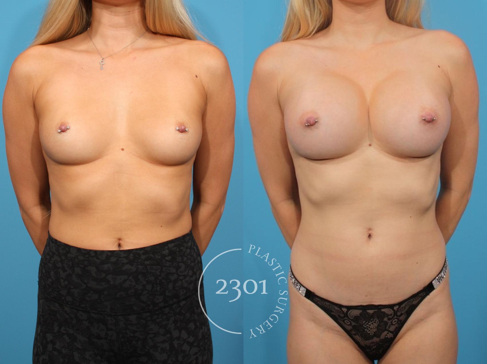 Before & After Breast Augmentation Case 816 Front View in Fort Worth, Plano, & Frisco, Texas