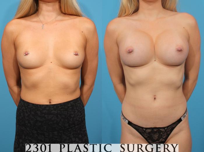 Before & After Breast Augmentation Case 816 Front View in Fort Worth, Plano, & Frisco, Texas