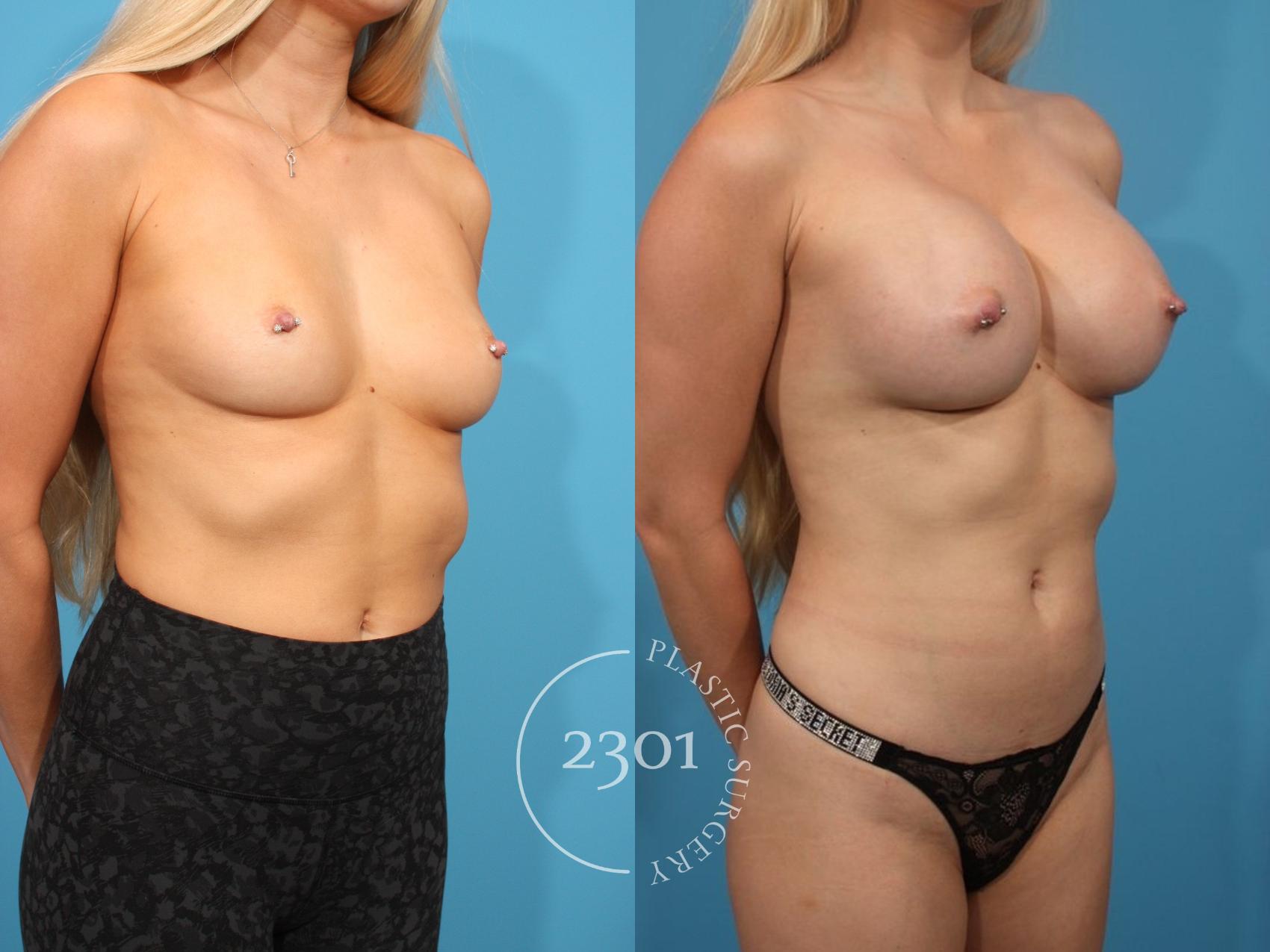 Before & After Silicone Implants Case 816 Right Oblique View in Fort Worth, Plano, & Frisco, Texas