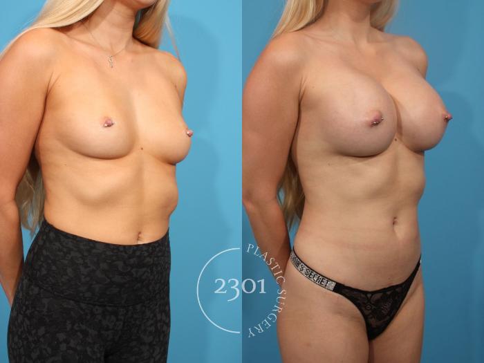 Before & After Breast Augmentation Case 816 Right Oblique View in Fort Worth, Plano, & Frisco, Texas