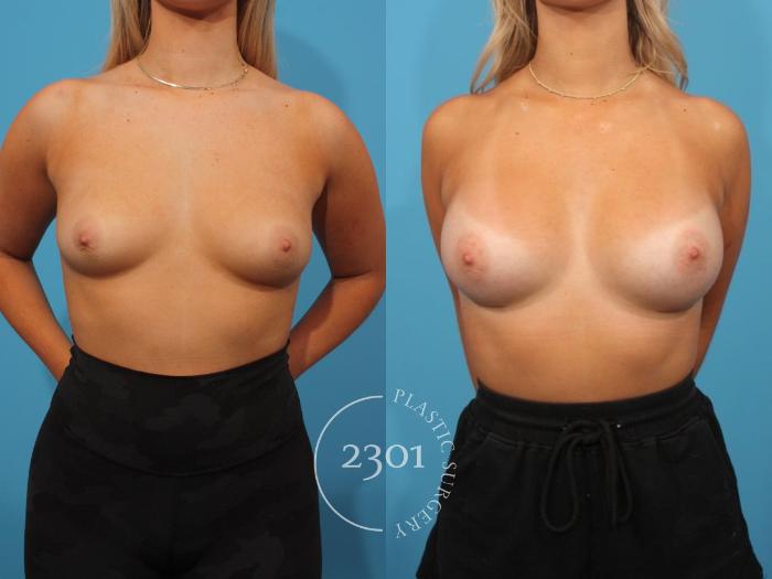 Before & After Breast Augmentation Case 817 Front View in Fort Worth, Plano, & Frisco, Texas