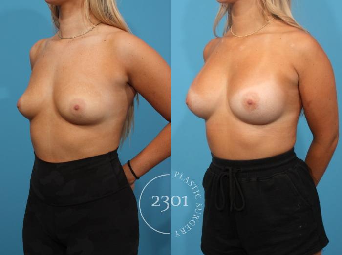 Before & After Breast Augmentation Case 817 Left Oblique View in Fort Worth, Plano, & Frisco, Texas