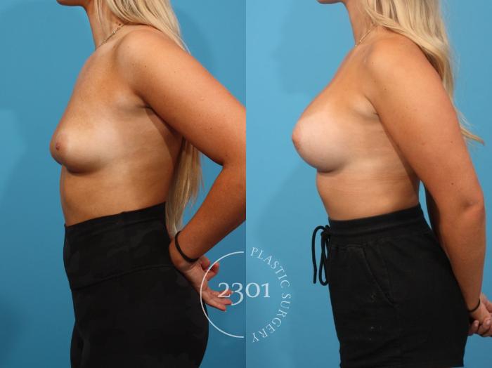 Before & After Breast Augmentation Case 817 Left Side View in Fort Worth, Plano, & Frisco, Texas