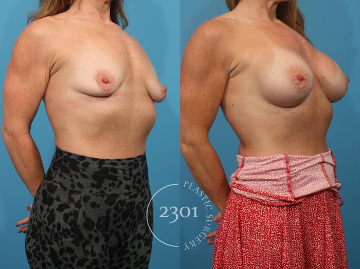 Before & After Breast Augmentation Case 874 Right Oblique View in Fort Worth, Plano, & Frisco, Texas