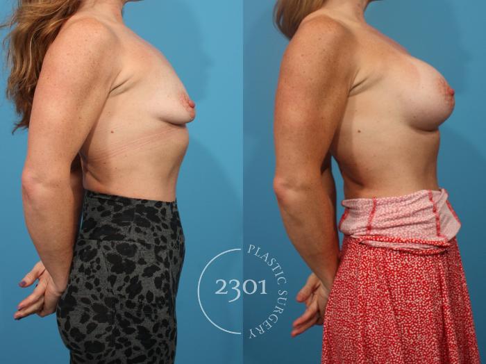 Before & After Breast Augmentation Case 874 Right Side View in Fort Worth, Plano, & Frisco, Texas
