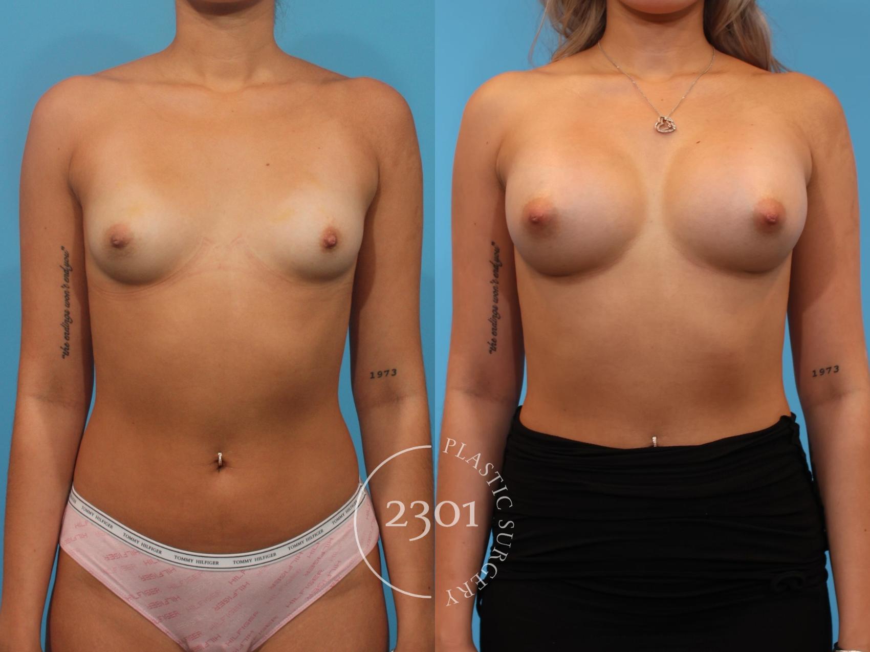 Before & After Breast Augmentation Case 903 Front View in Fort Worth, Plano, & Frisco, Texas