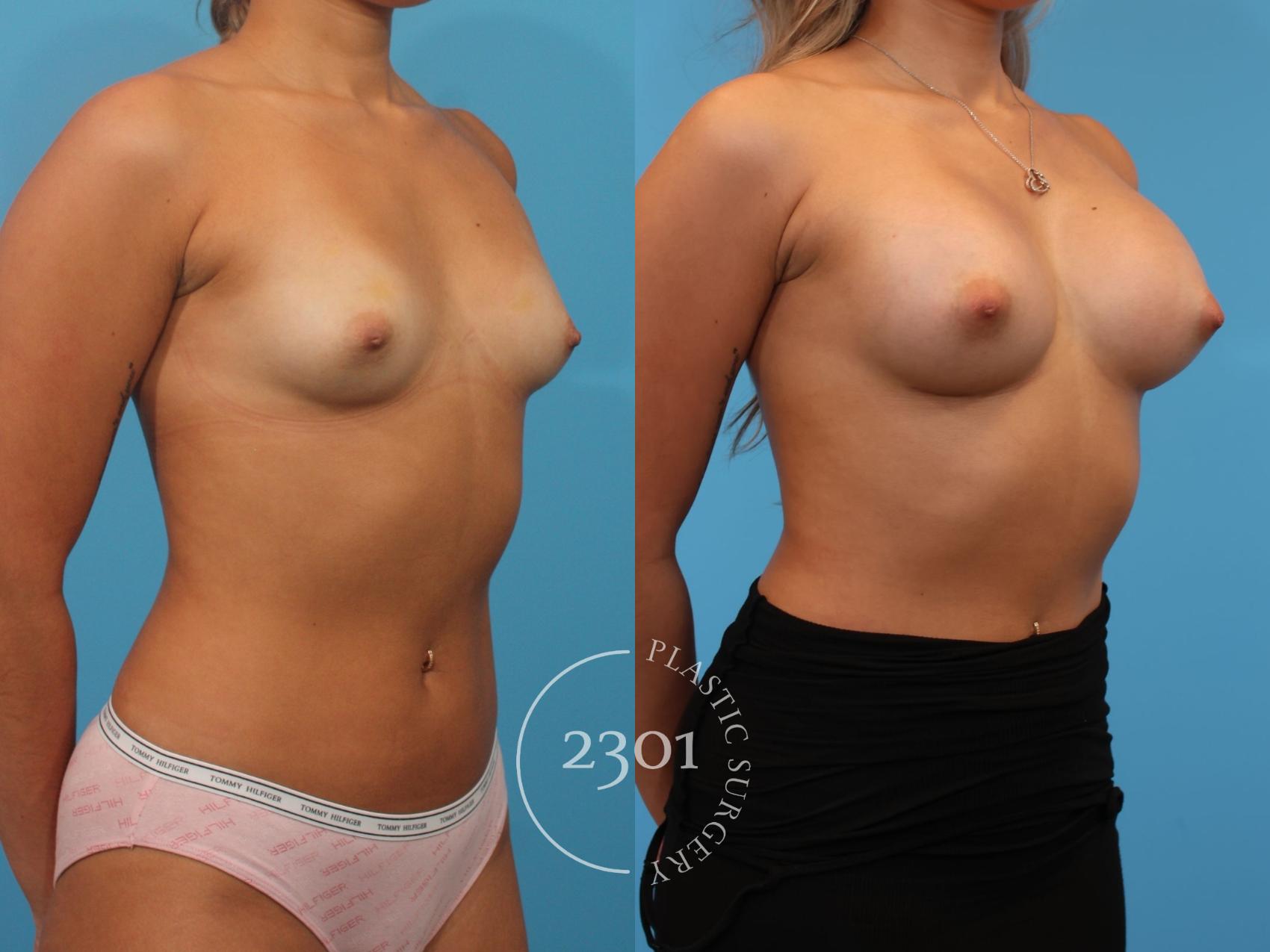 Before & After Breast Augmentation Case 903 Right Oblique View in Fort Worth, Plano, & Frisco, Texas