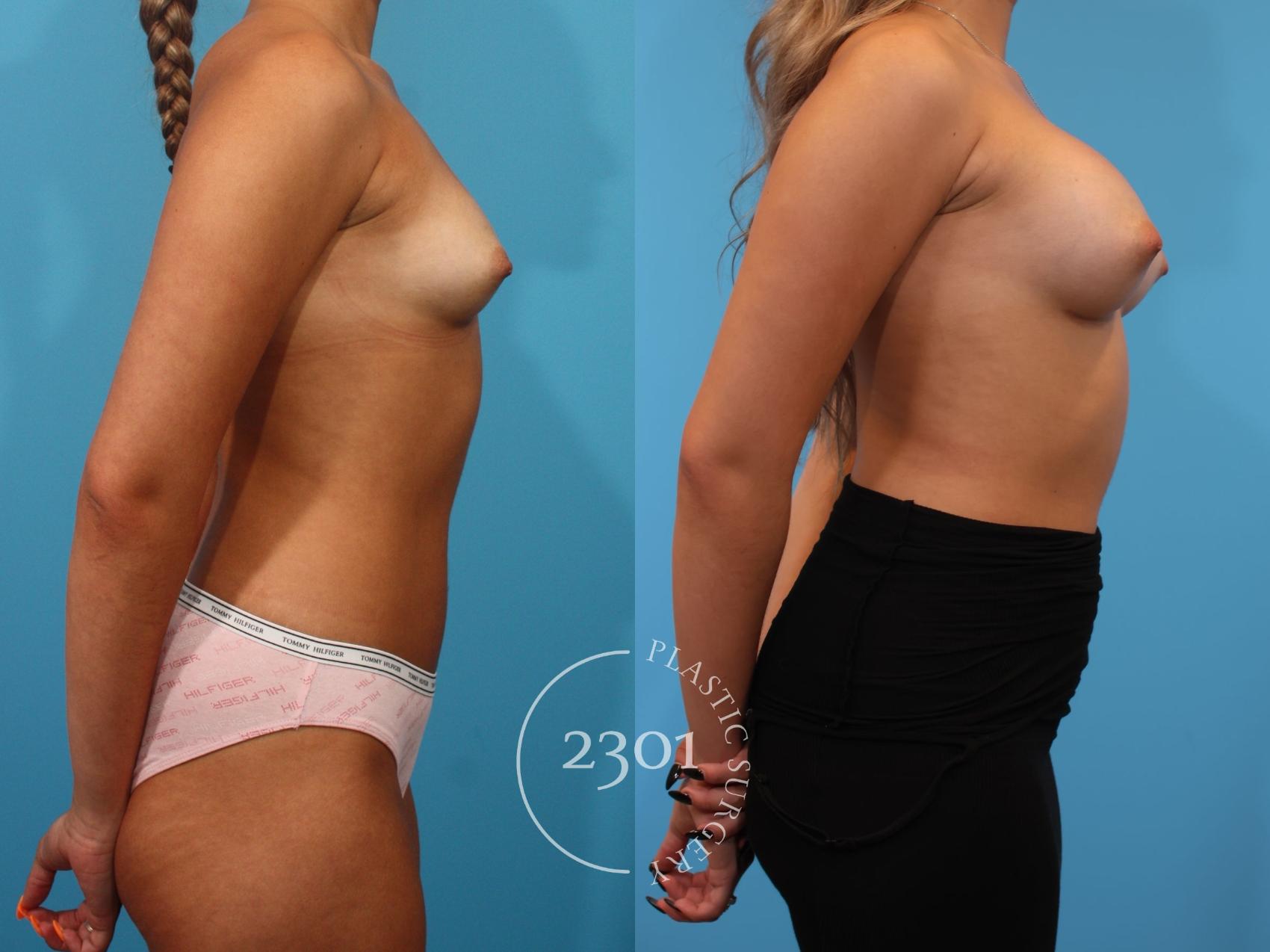 Before & After Breast Augmentation Case 903 Right Side View in Fort Worth, Plano, & Frisco, Texas
