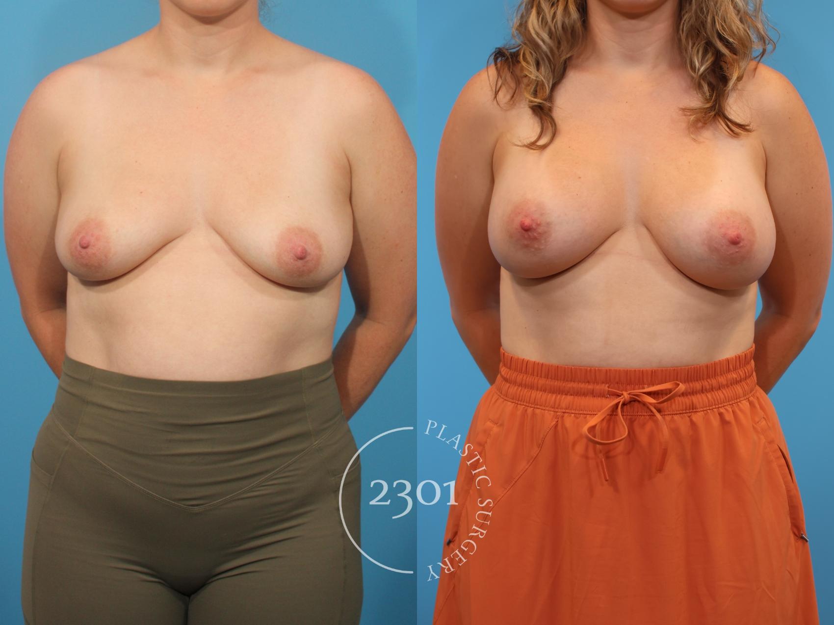 Before & After Breast Augmentation Case 911 Front View in Fort Worth, Plano, & Frisco, Texas
