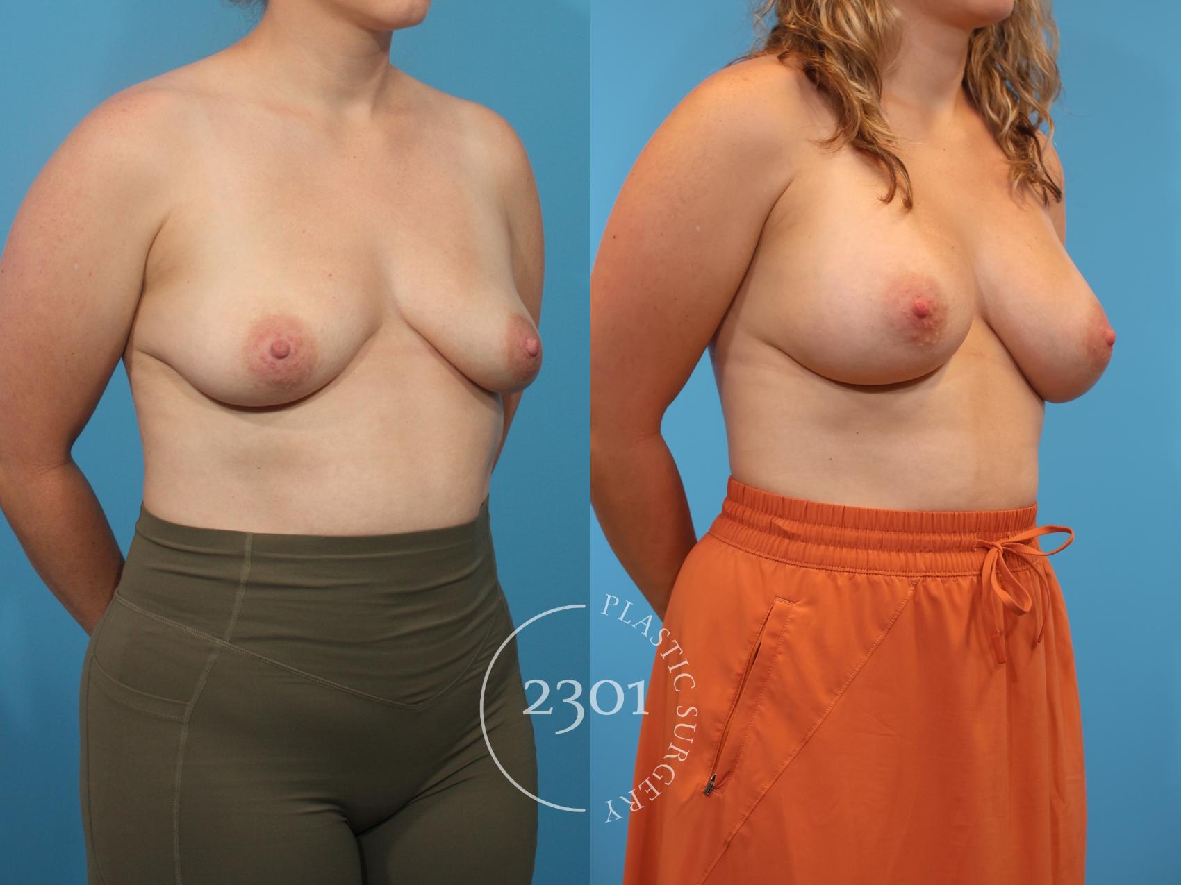 Before & After Breast Augmentation Case 911 Right Oblique View in Fort Worth, Plano, & Frisco, Texas