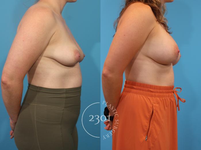Before & After Breast Augmentation Case 911 Right Side View in Fort Worth, Plano, & Frisco, Texas