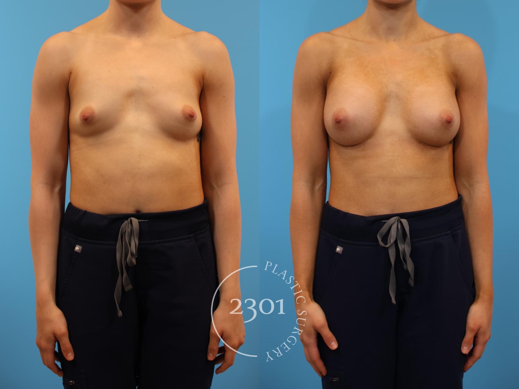 Before & After Breast Augmentation Case 915 Front View in Fort Worth, Plano, & Frisco, Texas