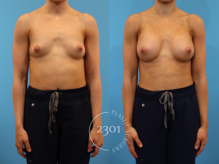 Before & After Breast Augmentation Case 915 Front View in Fort Worth, Plano, & Frisco, Texas